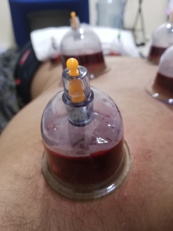 SAR 100,  Hijama Cupping/Cupping Therapy photo 1