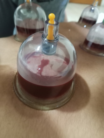 SAR 100,  Hijama Cupping/Cupping Therapy photo 2