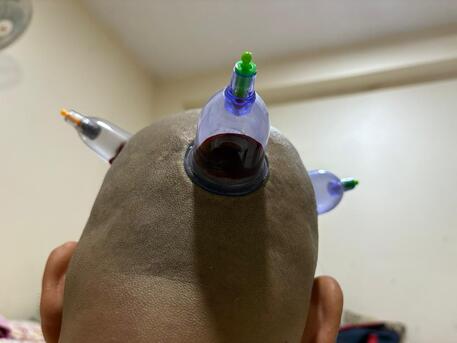 SAR 100,  Hijama Cupping/Cupping Therapy photo 3