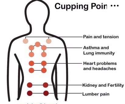 Hijama (Cupping Therapy)