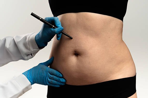 Liposuction in Riyadh