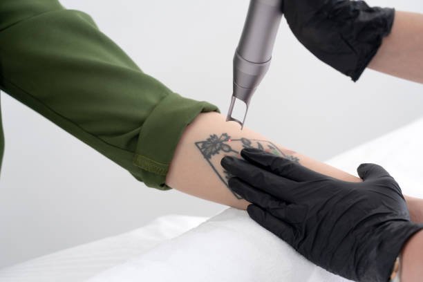 Laser Tattoo Removal in Riyadh